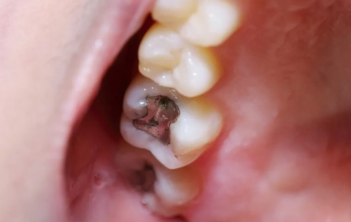 cavity pain relief cavity pain relief