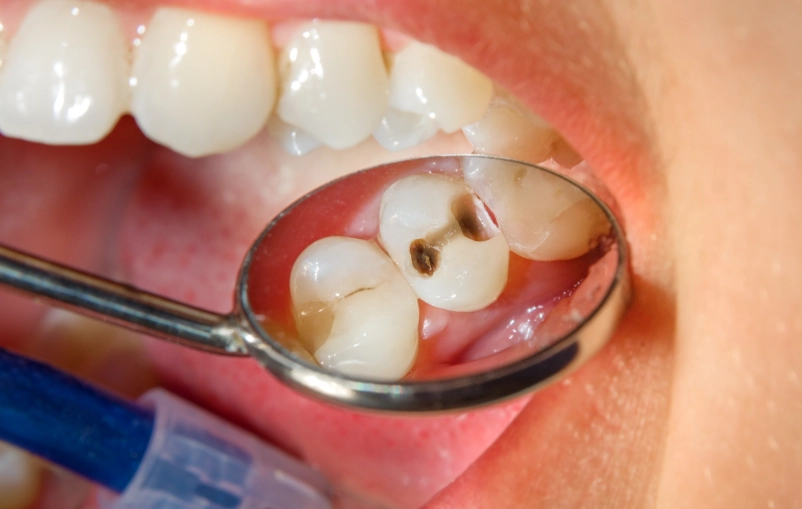 how to stop toothache from cavity how to stop toothache from cavity