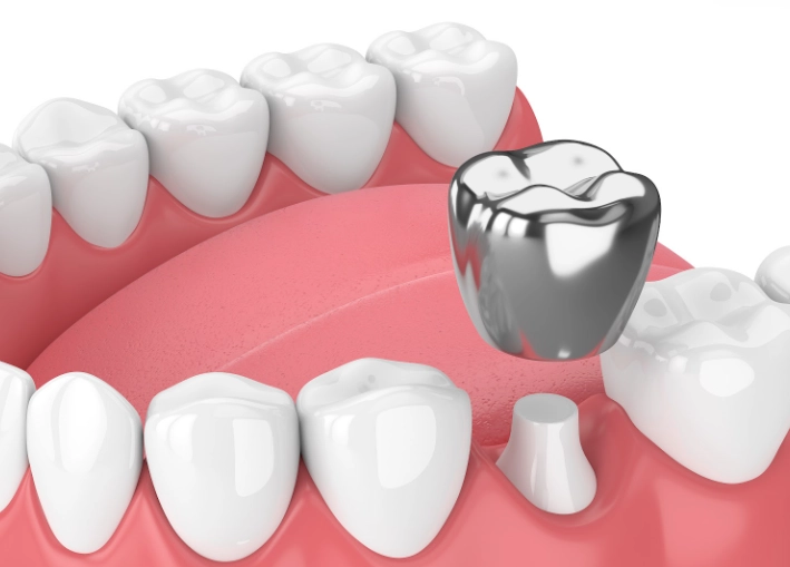 crown recementation cost