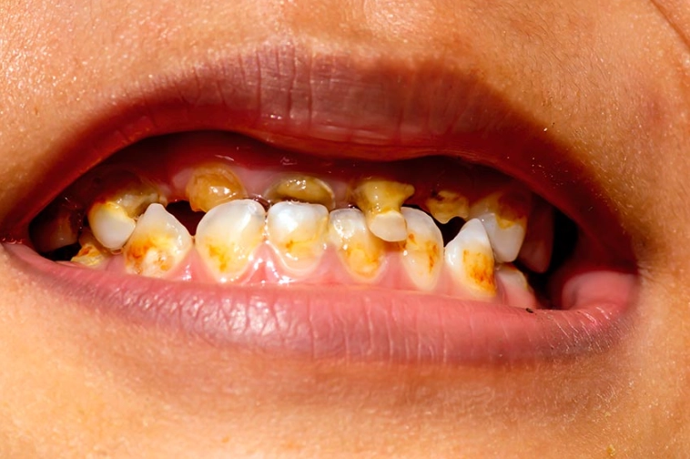 What happens if milk teeth decay?