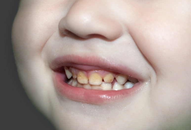 baby teeth cavities