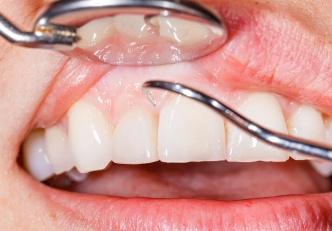 periodontal scaling and root planing healing