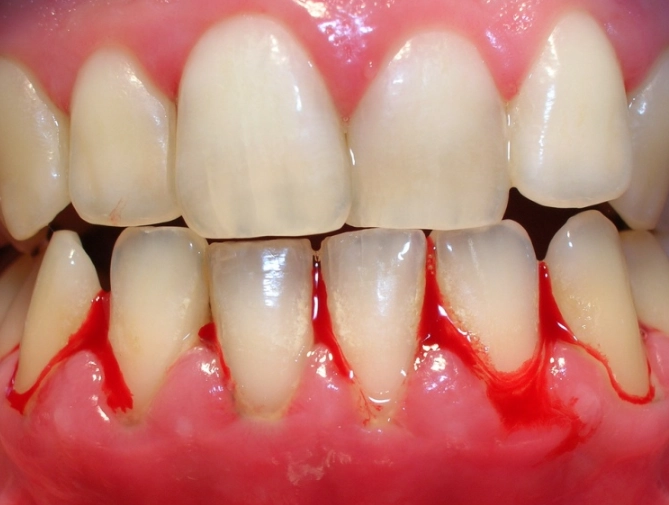 e-gingivalis oral bacteria