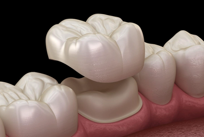 dental crown glue price