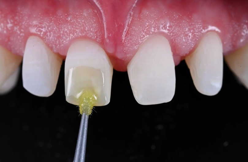 tooth crown repair cost