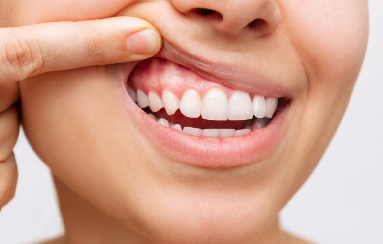 pediatric gum disease