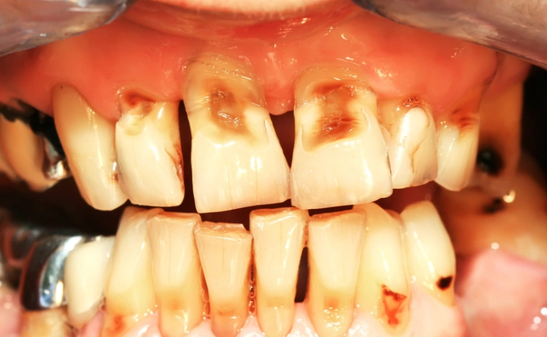 citric acid tooth damage citric acid tooth damage