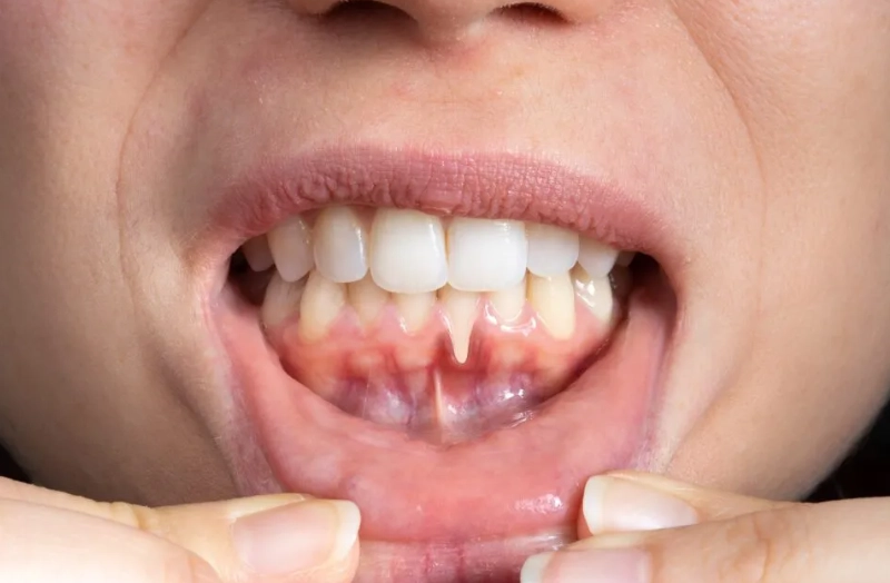 receding gums in children