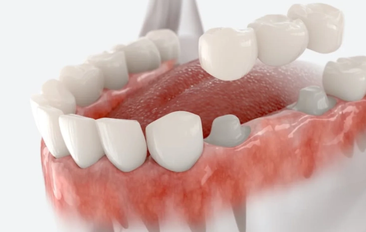 crown recementation cost
