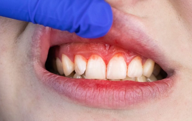 deep cleaning teeth recovery time