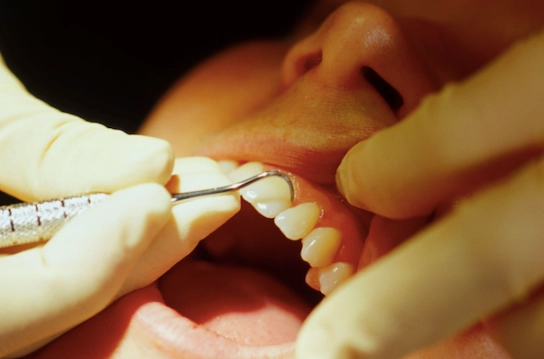 receding gums in children