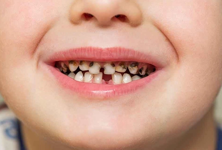 how to fix milk rot teeth