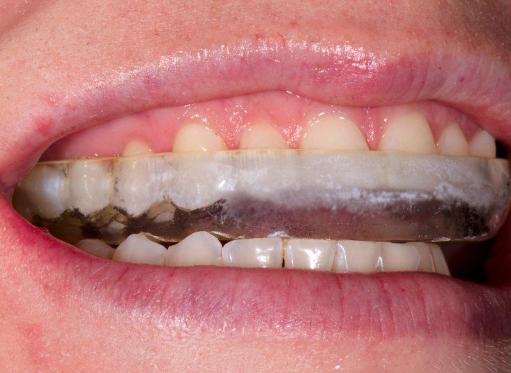 soft night guard for teeth grinding