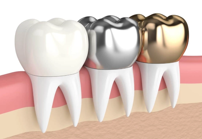 tooth crown repair cost