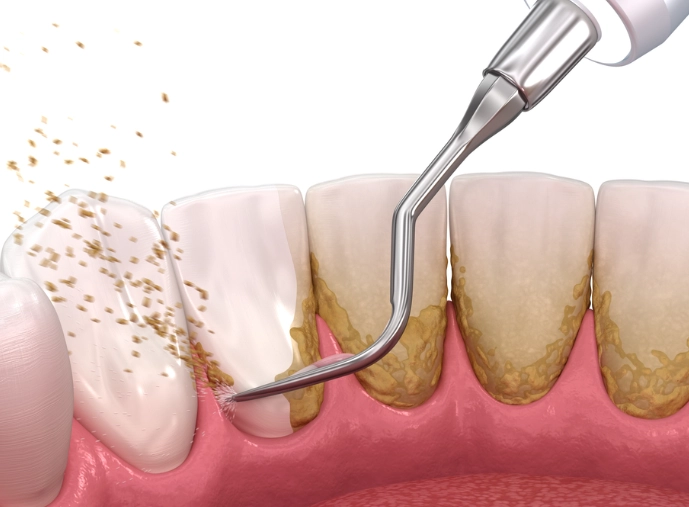 how to remove tartar from teeth
