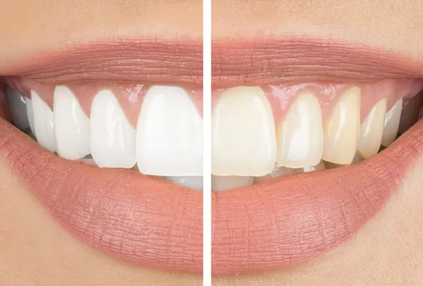 safe teeth whitening