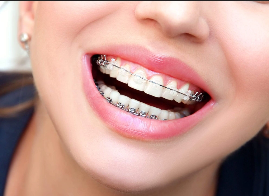 ceramic vs metal braces