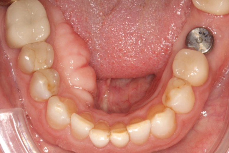 dental tori treatment