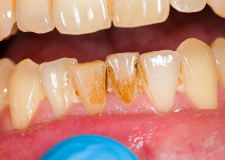 tartar plaque removal