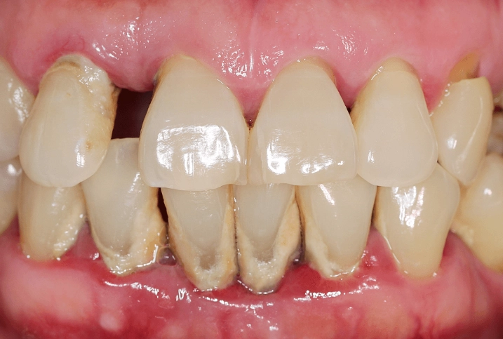 how to remove tartar from teeth