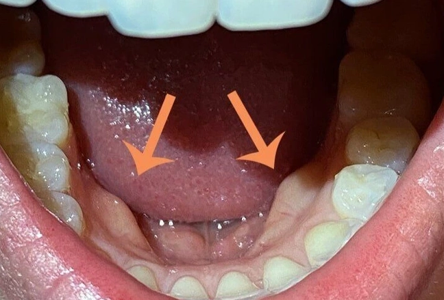 hard lump inside mouth lower jaw