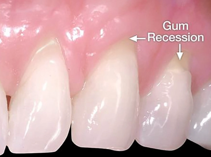 how to reverse gum recession