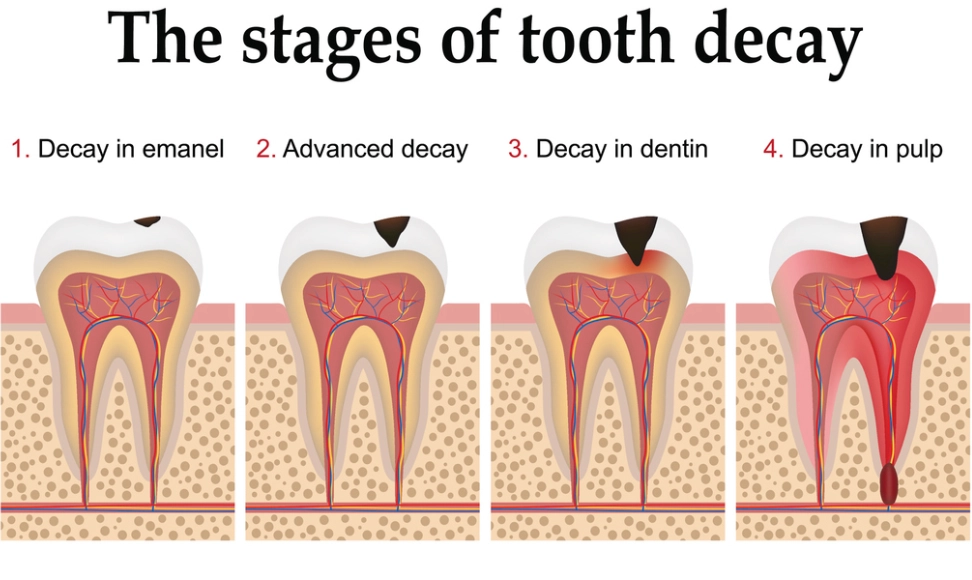 reverse tooth decay