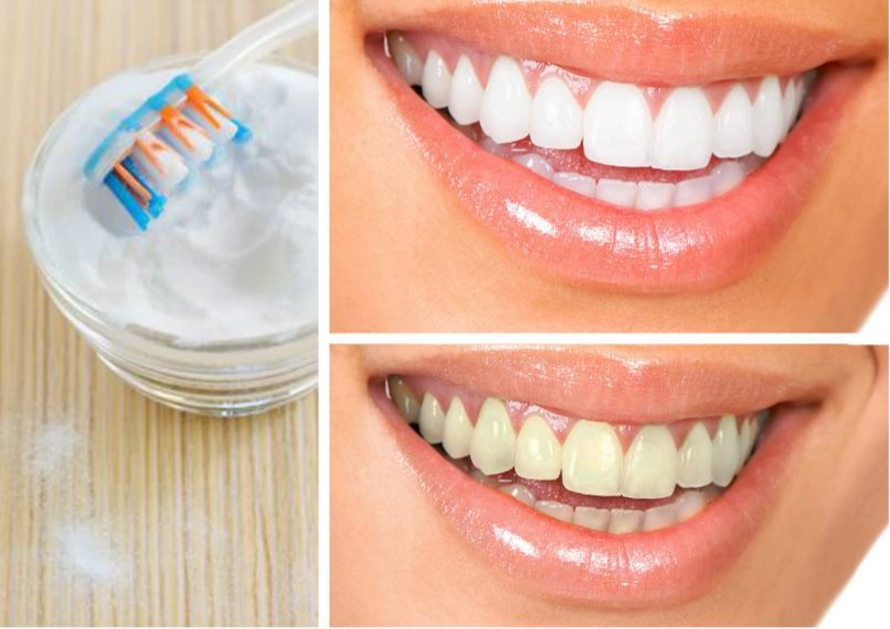 safe teeth whitening