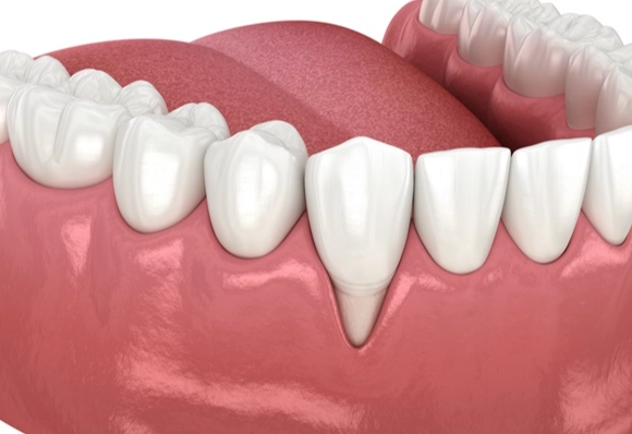 how to reverse gum recession