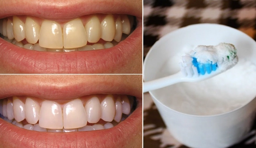 how to whiten teeth with baking soda