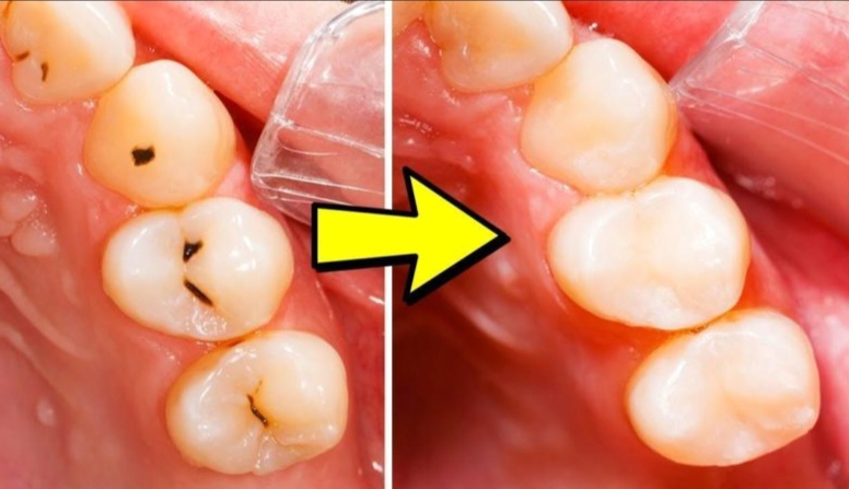 tooth decay stages tooth decay stages