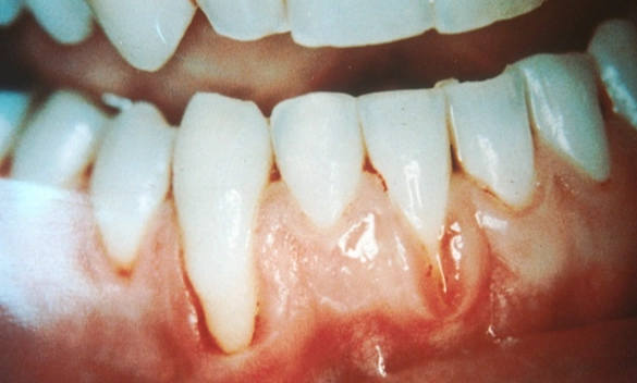 how to reverse gum recession
