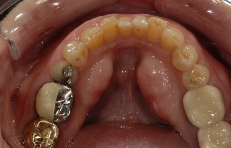 hard lump inside mouth lower jaw