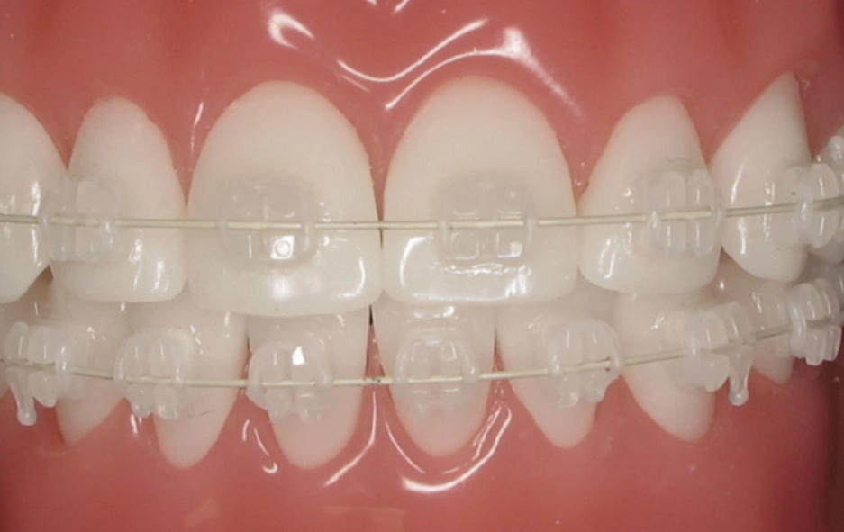 ceramic vs metal braces