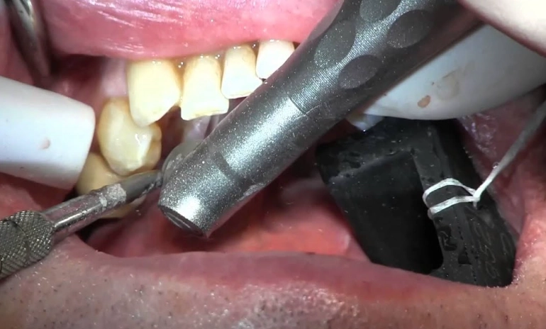 dental tori treatment