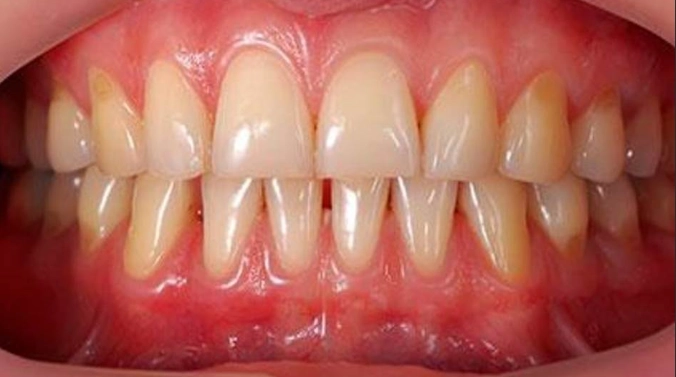 can receding gums grow back