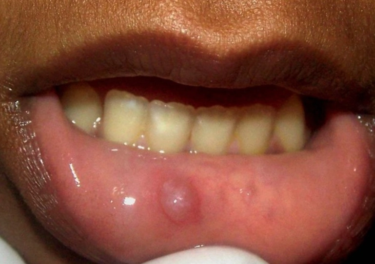 jaw lump inside mouth