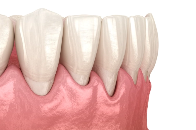 how to reverse gum recession