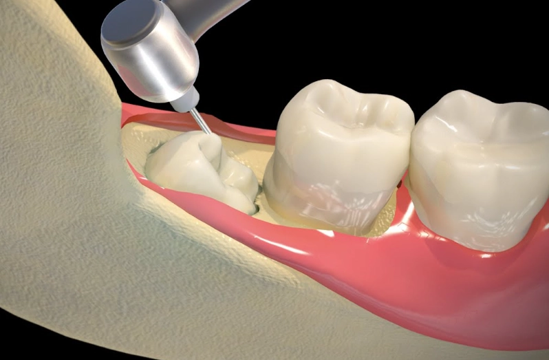 wisdom teeth removal day 7