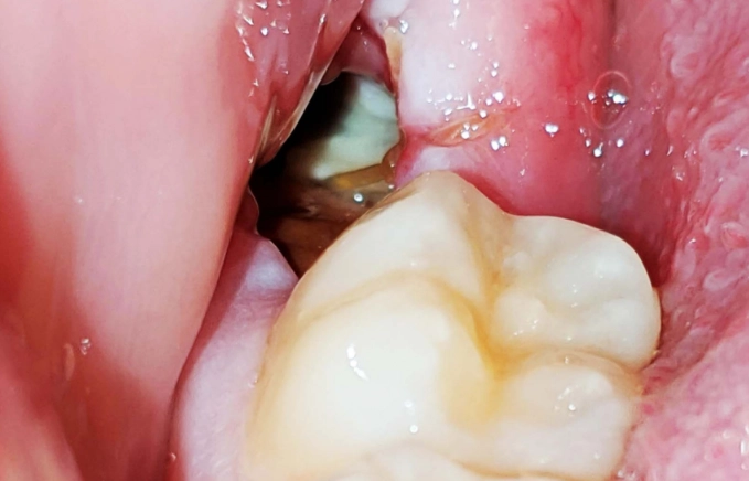 wisdom teeth recovery day 7