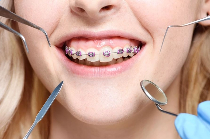 braces cost