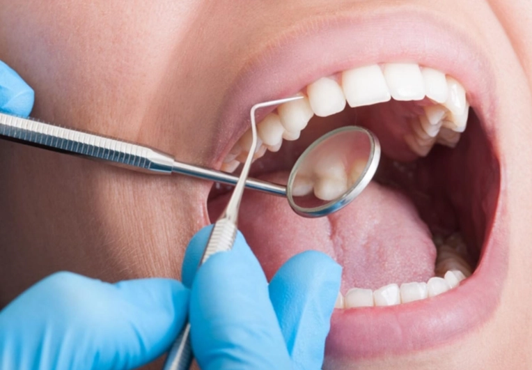 gentle teeth cleaning