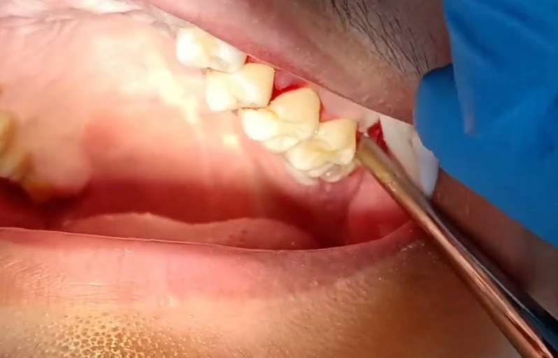 day 7 wisdom teeth removal recovery