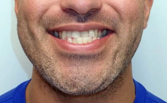 underbite correction