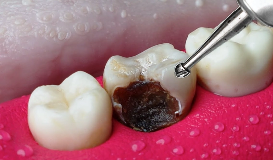 how to heal cavities naturally