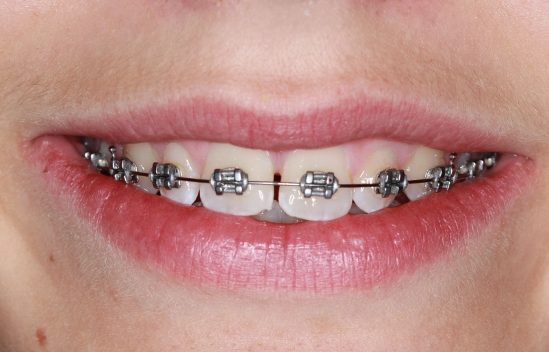 how much do braces cost