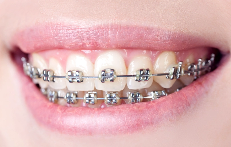 types of braces