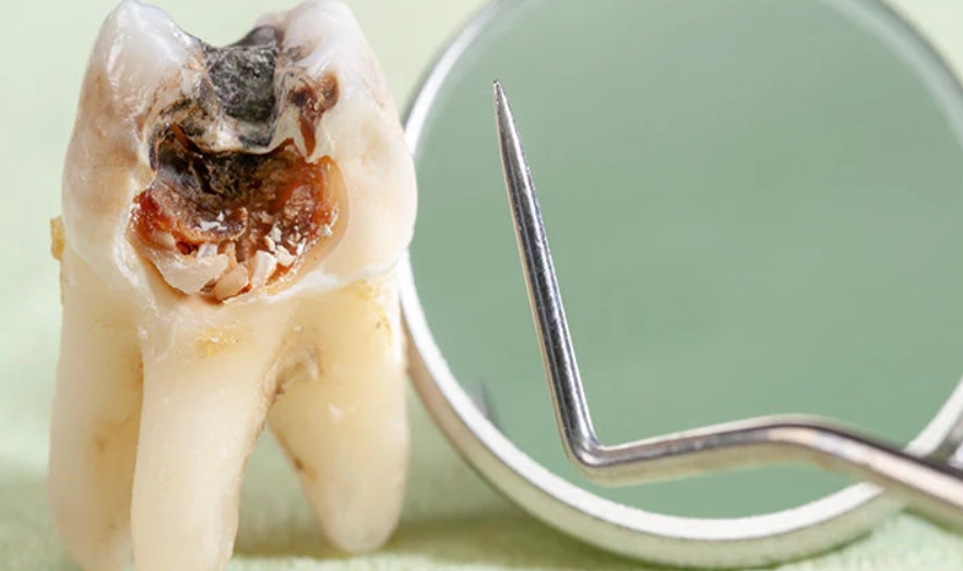 how to heal cavities naturally