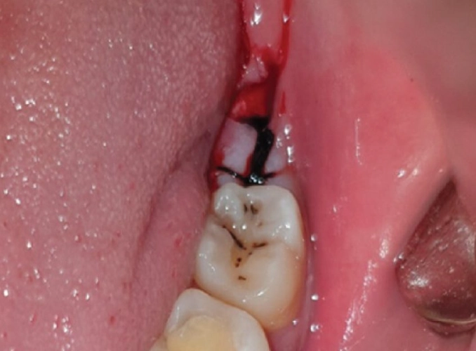 day 7 wisdom teeth removal recovery