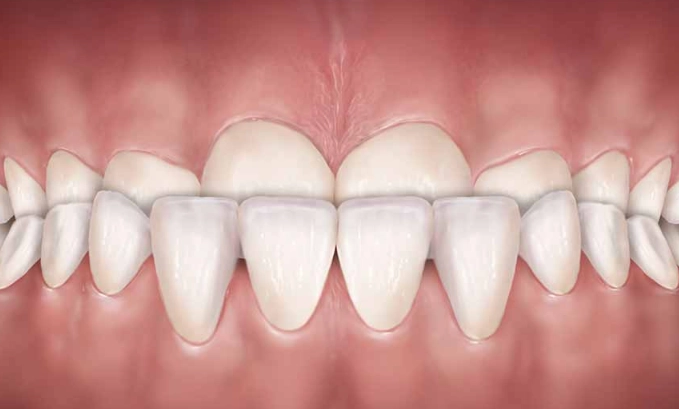 underbite correction